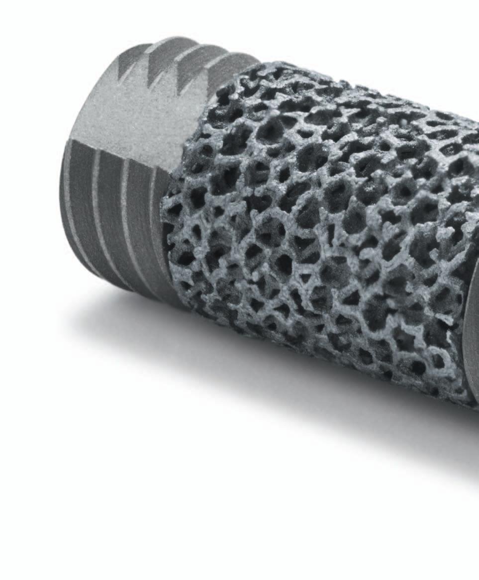 Zimmer-Biomet Trabecular Metal Implant dentaire | SpotImplant