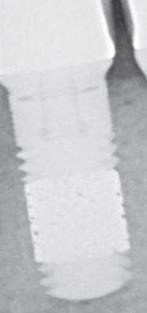 Zimmer-Biomet Trabecular Metal Implant dentaire | SpotImplant