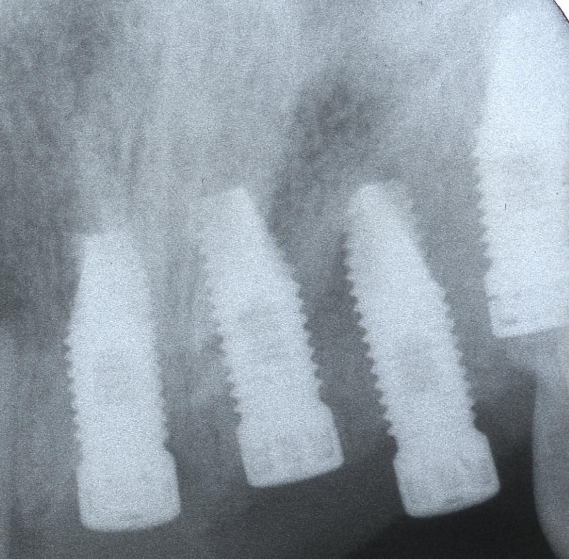 Zimmer Spline Twist Implant dentaire SpotImplant