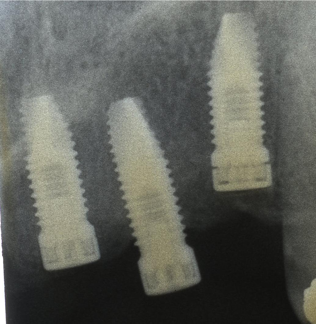 Zimmer Spline Twist Dental Implant SpotImplant